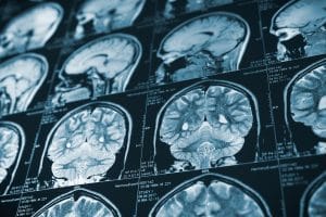 Traumatic Brain Injuries Can Lead to Lifelong Complications, Like Aphasia