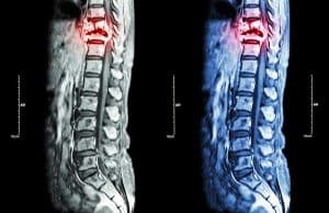 Respiratory Complications Caused by Spinal Cord Injury and Trauma 