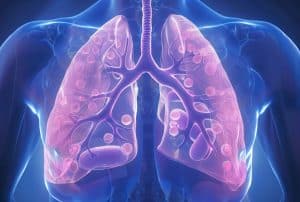 Post-Traumatic Pulmonary Embolisms Can Be Life-Threatening